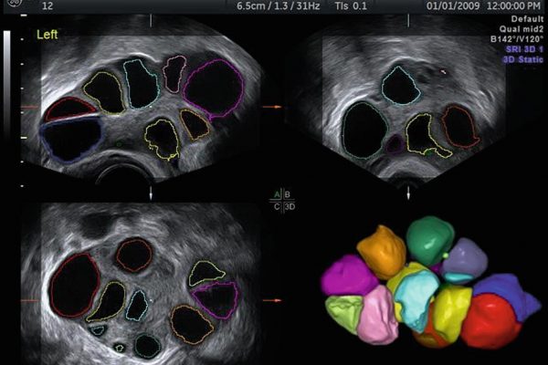 Stimulacija ovulacije u IVF centru Zavoda Mehmedbašić Sarajevo